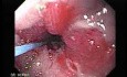 Endoscopic Baloon Dilation Of The Esophageal Stricture - Position Of The Deflated Baloon