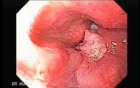 Squamous cell carcinoma of the larynx 73-year-old smoker (1 of 4)