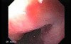 Gastroesophagic Varices - 66 - Year - Old Man (5 of 7) 