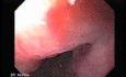 Gastroesophagic Varices - 66 - Year - Old Man (5 of 7) 