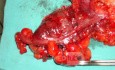 Severe case of Ischemic Colitis (14 of 19)