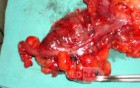 Severe case of Ischemic Colitis (14 of 19)