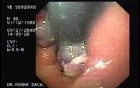 Acute Variceal Bleeding - Retroflexed View of Gastric Cardias 