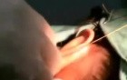Auriculoplasty 