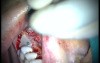 Regeneration Of Multialveolar Process 16-17 (1/4