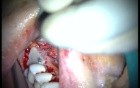 Regeneration Of Multialveolar Process 16-17 (1/4