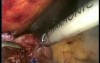 Conversion of Nissen Fundoplication to Roux en Y Gastric Bypass - Laparoscopy