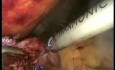 Conversion of Nissen Fundoplication to Roux en Y Gastric Bypass - Laparoscopy