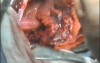 Lobectomy With Lymphadenectomy