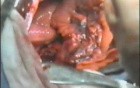 Lobectomy With Lymphadenectomy