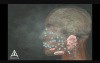 Sialorrhea Injection Site Identification - 3D Medical Animation