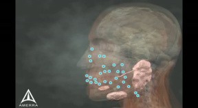 Sialorrhea Injection Site Identification - 3D Medical Animation