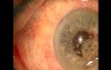 Surgical management of capsule contraction syndrome