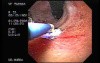 Mallory-Weiss Syndrome - Hemostatic Therapy with Argon Plasma Coagulator, Part 1