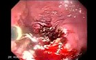 Debulking Of The Esophageal Tumor - Forceps - 1/2