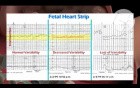 Cerebral Hypoxia