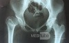 Coxa Plana Rt. Hip