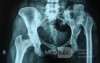 Neglected CDH left HIP