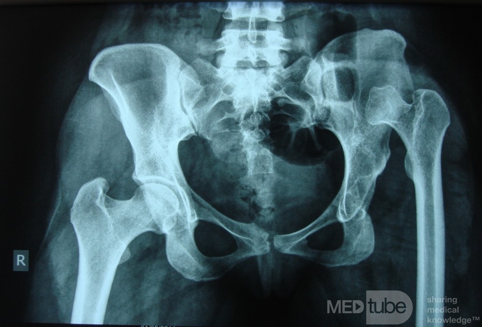 Neglected CDH left HIP