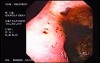Zollinger- Ellison Syndrome - Gastric Ulcer with Gastrocolic Fistula (3 of 21)