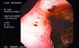 Zollinger- Ellison Syndrome - Gastric Ulcer with Gastrocolic Fistula (3 of 21)