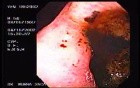 Zollinger- Ellison Syndrome - Gastric Ulcer with Gastrocolic Fistula (3 of 21)