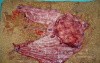 Adenocarcinoma of the cardias and gastric fundus with signet-ring cells (10 of 25)