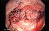 Severe case of Ischemic Colitis (11 of 19)