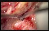 Second – Look Tympanoplasty 