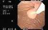 Endoscopic treatment of complications after  GIST removal