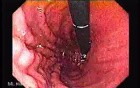 Esophageal Varices - Endoscopy (4 of 5)
