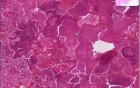 Aspiration pneumonia, infant