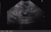 Cystic tumor in pancreas