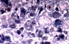 Endoscopy of Scirrhous Gastric Carcinoma involving the entire Fundus, Body and the Antrum (6 of 47)