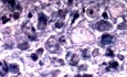 Endoscopy of Scirrhous Gastric Carcinoma involving the entire Fundus, Body and the Antrum (6 of 47)