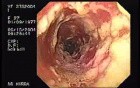 Oropharynge-Esophagic Candidiasis HIV-positive female patient (1 of 5)