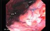 Adenocarcinoma of the Lesser Curvature with Signet Ring Cells (7 of 8)