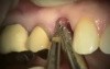 Upper Right Premolar Implant Microsurgery