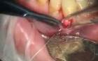 Grafting With Purified Collagen Implants