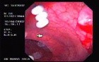 Rectal Cancer That Emerges In The Pectin Line (3 of 3)