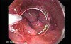 Early Gastric Cancer of the Gastroesophageal Junction - Injection of Solutions to Perform the Mucosectomy