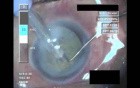 Cataract Surgery 3 - Part 2