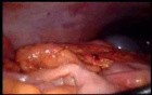 Colonic Perforation With Peritonitis - Laparoscopy (29 of 46)