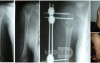 Unicameral Bone Cyst 