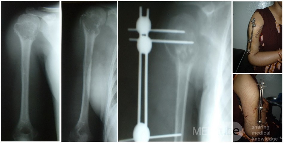 Unicameral Bone Cyst 
