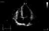 Hypertensive Heart Disease - Cardiomyopathy