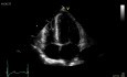 Hypertensive Heart Disease - Cardiomyopathy