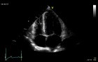 Hypertensive Heart Disease - Cardiomyopathy