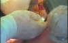 Gastric Cancer Surgery - Distal Gastrectomy