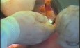 Gastric Cancer Surgery - Distal Gastrectomy